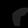 SPORK, NICO - 22.03.1976 - 02.08.2022 - CT obere Extremität - 17:59:07